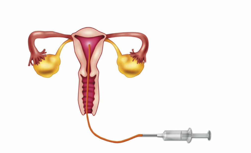 如何提高人工授精的成功率 針灸能提高人工授精成功率嗎 如何提高人工授精的成功率 針灸能提高人工授精成功率嗎