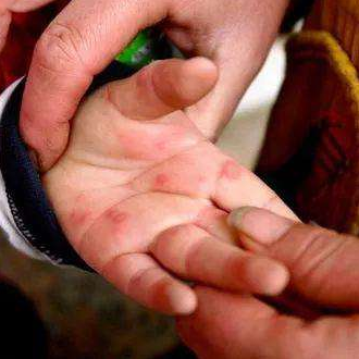 得手足口病的孩子會恢復嗎 孩子怎么預防手足口病2018