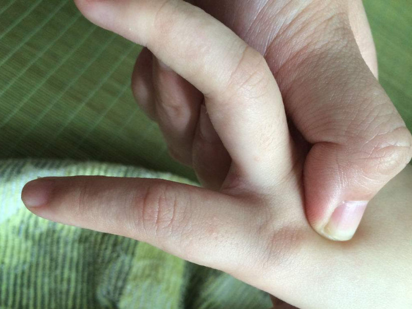 得手足口病的孩子會恢復嗎 孩子怎么預防手足口病2018