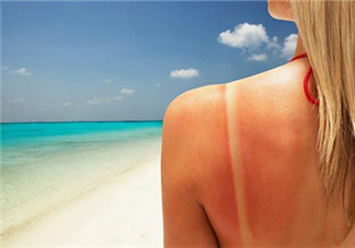 夏天曬傷了怎么護理 曬傷后要注意什么2018