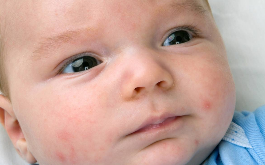 怎么看出寶寶過敏 過敏種類及處理方法2018