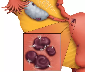 得了巧克力囊腫還能懷孕嗎 得巧克力囊腫的原因是什么