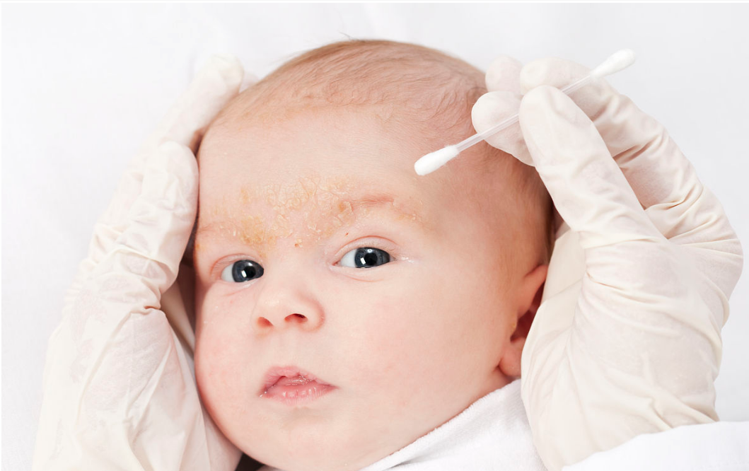 新生兒常見皮膚問題如何分辨 寶寶皮炎怎么護理清潔 新生兒常見皮膚問題如何分辨 寶寶皮炎怎么護理清潔