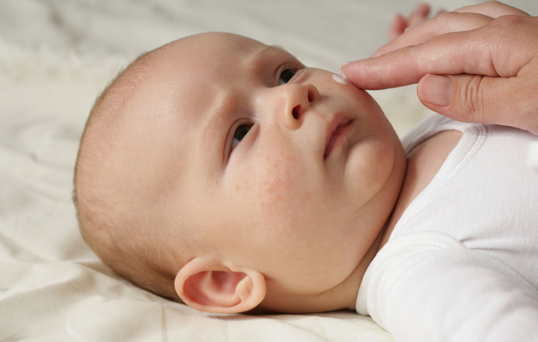 新生兒常見皮膚問題如何分辨 寶寶皮炎怎么護理清潔 新生兒常見皮膚問題如何分辨 寶寶皮炎怎么護理清潔