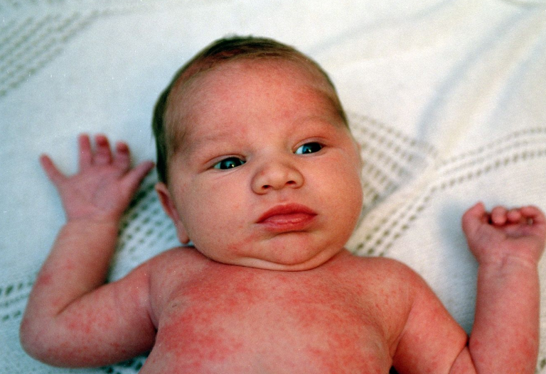 孩子有痱子怎么去痱 預防孩子長痱子方法2018