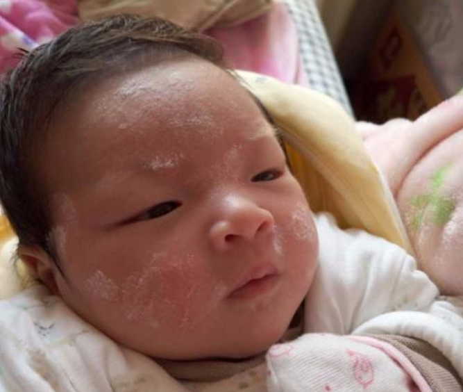 孩子有痱子怎么去痱 預防孩子長痱子方法2018