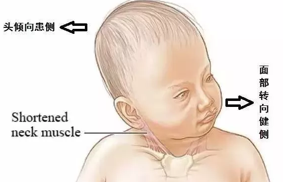 寶寶喜歡歪脖子家長怎么抱 寶寶歪脖子治療方法2018
