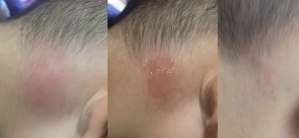 寶寶用木瓜膏有副作用嗎 木瓜膏寶寶用了會過敏嗎 寶寶用木瓜膏有副作用嗎 木瓜膏寶寶用了會過敏嗎