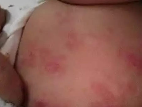 夏天寶寶紅點痱子還是濕疹 夏天寶寶身上有紅點原因