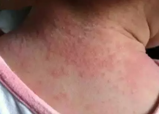 夏天寶寶紅點(diǎn)痱子還是濕疹 夏天寶寶身上有紅點(diǎn)原因