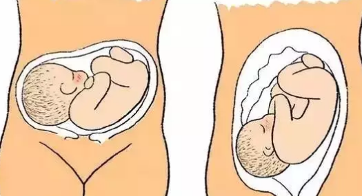 孕晚期胃有很燒心的感覺怎么辦 臨產前的胃灼感怎么緩解