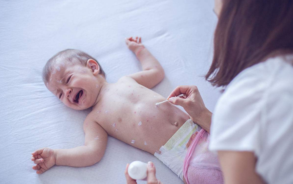 孩子過敏了不能吃什么 如何預防高過敏因子