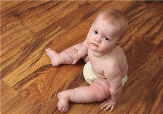 小孩長了蕁麻疹打針還是吃藥 小孩長蕁麻疹怎么辦