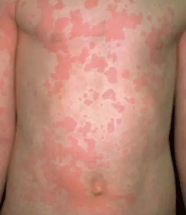 小孩長了蕁麻疹打針還是吃藥 小孩長蕁麻疹怎么辦