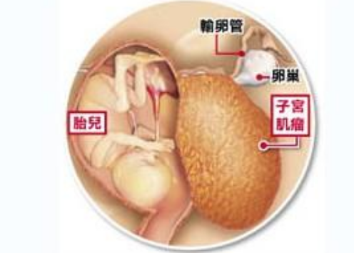 懷孕子宮肌瘤的常見癥狀 子宮肌瘤會引起不孕癥嗎