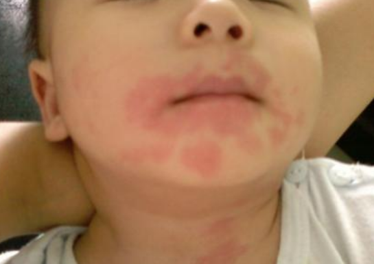 牛奶蛋白過敏寶寶幾歲恢復正常2018 怎么發(fā)現寶寶對牛奶蛋白過敏