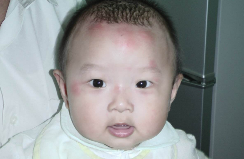 寶寶被蚊子叮咬后紅點怎么消除 為什么寶寶蚊子叮咬后紅腫