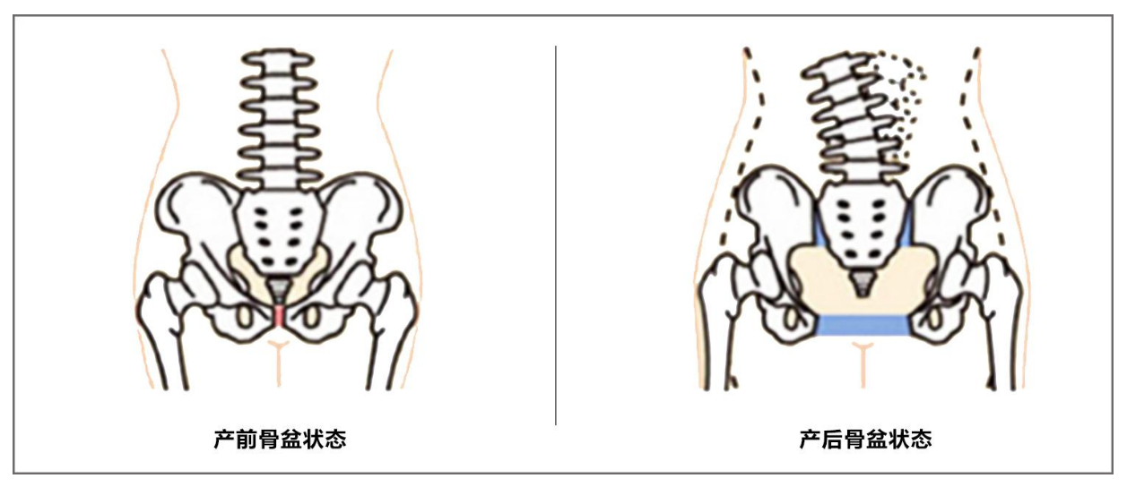 產后骨盆矯正帶有用嗎 骨盆矯正帶怎么用有效2018
