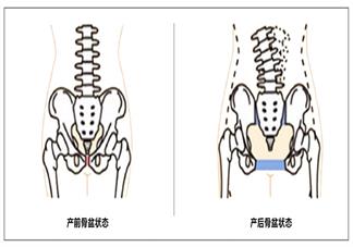 產后骨盆矯正帶有用嗎 骨盆矯正帶怎么用有效2018