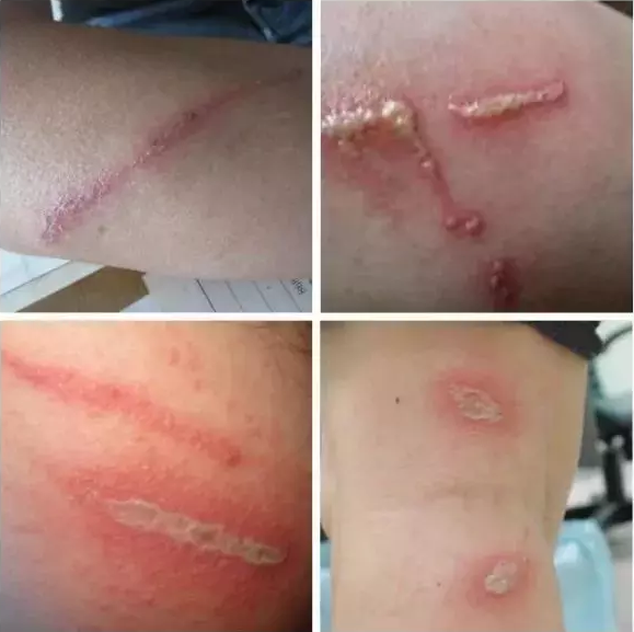 被隱翅蟲叮了怎么辦 怎么預防被隱翅蟲叮2018