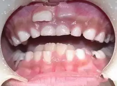 孩子長雙排牙是怎么回事 怎么避免孩子長雙排牙 孩子長雙排牙是怎么回事 怎么避免孩子長雙排牙