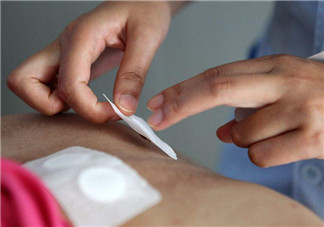 貼三伏貼起泡發紅正常嗎 貼三伏貼起泡需要怎樣處理 貼三伏貼起泡發紅正常嗎 貼三伏貼起泡需要怎樣處理