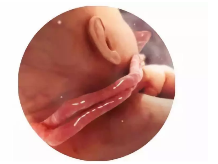 臍帶繞頸一周危險(xiǎn)嗎 蔣勤勤寶寶臍帶繞頸一周怎么辦