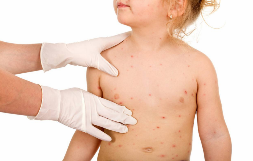 寶寶會將水痘傳染給母親嗎 寶寶有什么治療方法 