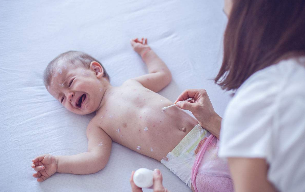 寶寶會將水痘傳染給母親嗎 寶寶有什么治療方法 