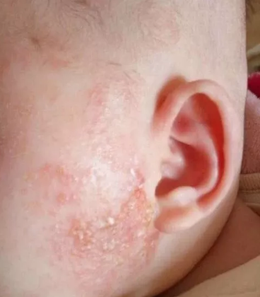 孩子濕疹和痱子有什么差別 孩子濕疹和痱子怎么護理比較好