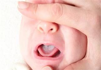 寶寶嘴邊有白色的東西是什么 白色的東西是鵝口瘡嗎