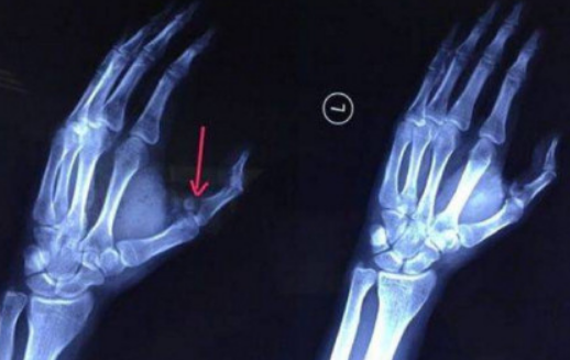 冰可樂掉地上撿起后爆炸原因 男生撿可樂手指被炸骨折