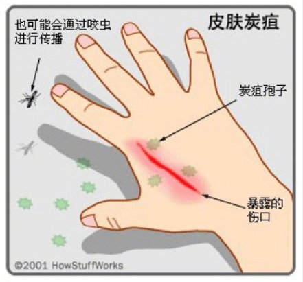 人是怎么感染上炭疽的 人類感染炭疽的三種途徑