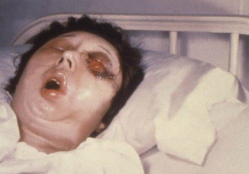 人感染炭疽的癥狀有哪些 人得了炭疽病的圖片2018 人感染炭疽的癥狀有哪些 人得了炭疽病的圖片2018