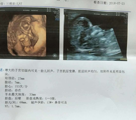 NT值檢查過大是什么原因 NT檢查值過大寶寶危險嗎