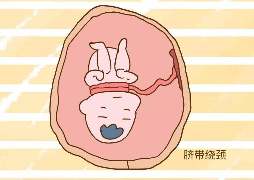 懷孕的時候怎么做可以避免臍帶繞頸 胎兒臍帶繞頸怎么緩解 懷孕的時候怎么做可以避免臍帶繞頸 胎兒臍帶繞頸怎么緩解