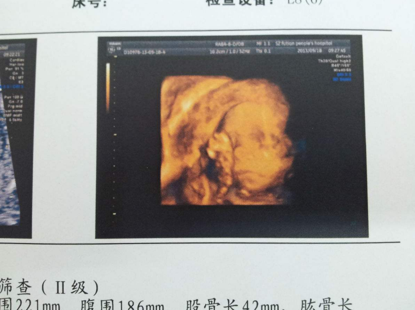 懷孕的時候怎么做可以避免臍帶繞頸 胎兒臍帶繞頸怎么緩解 懷孕的時候怎么做可以避免臍帶繞頸 胎兒臍帶繞頸怎么緩解