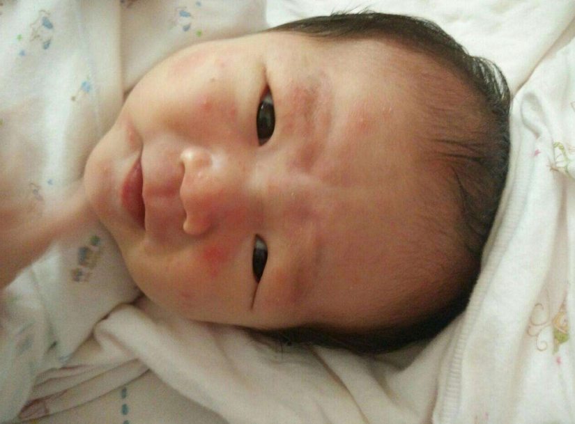 寶寶出生全身是黃色的是胎毒嗎 寶寶體內的胎毒怎么去