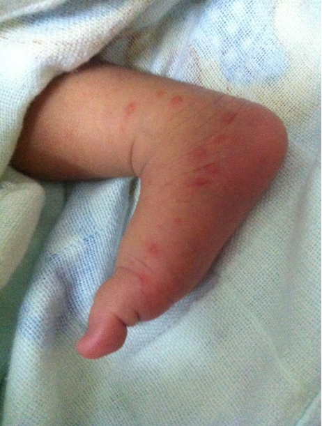 寶寶出生全身是黃色的是胎毒嗎 寶寶體內的胎毒怎么去