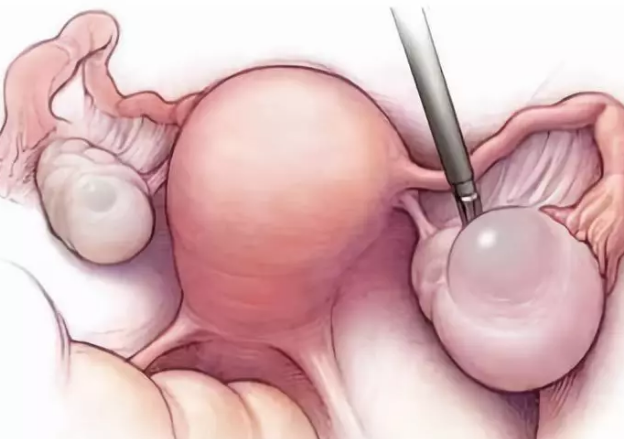 輸卵管積水能做試管嬰兒嗎 輸卵管積水怎么預防2018 輸卵管積水能做試管嬰兒嗎 輸卵管積水怎么預防2018