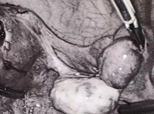 輸卵管有積水會影響胚胎移植嗎 輸卵管積水會影響胚胎移植成功率嗎 輸卵管有積水會影響胚胎移植嗎 輸卵管積水會影響胚胎移植成功率嗎