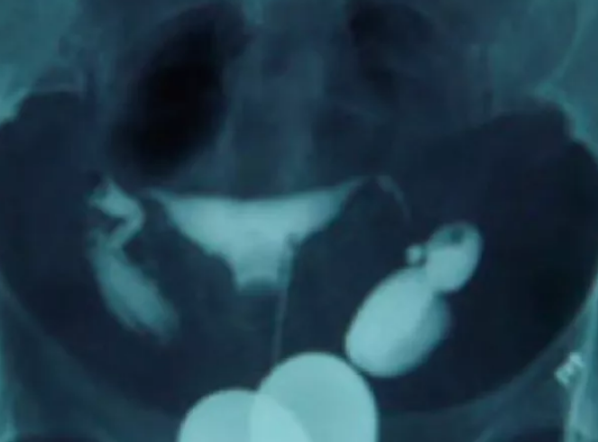 輸卵管有積水會影響胚胎移植嗎 輸卵管積水會影響胚胎移植成功率嗎 輸卵管有積水會影響胚胎移植嗎 輸卵管積水會影響胚胎移植成功率嗎