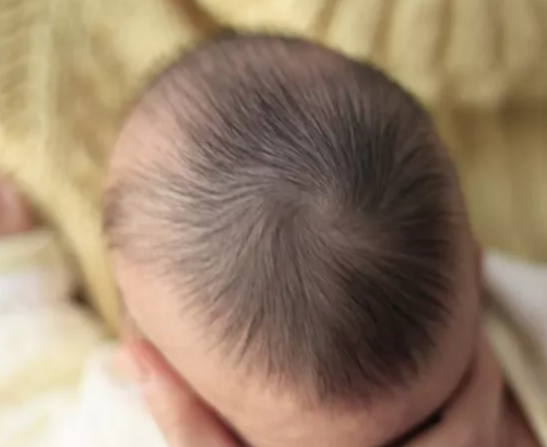 寶寶出現枕禿是因為缺鈣嗎 寶寶枕禿多大會長齊 寶寶出現枕禿是因為缺鈣嗎 寶寶枕禿多大會長齊