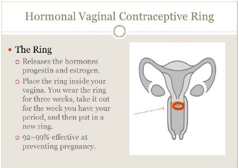 女用長效避孕環避孕原理是什么 女用長效避孕環為什么放進去就能避孕