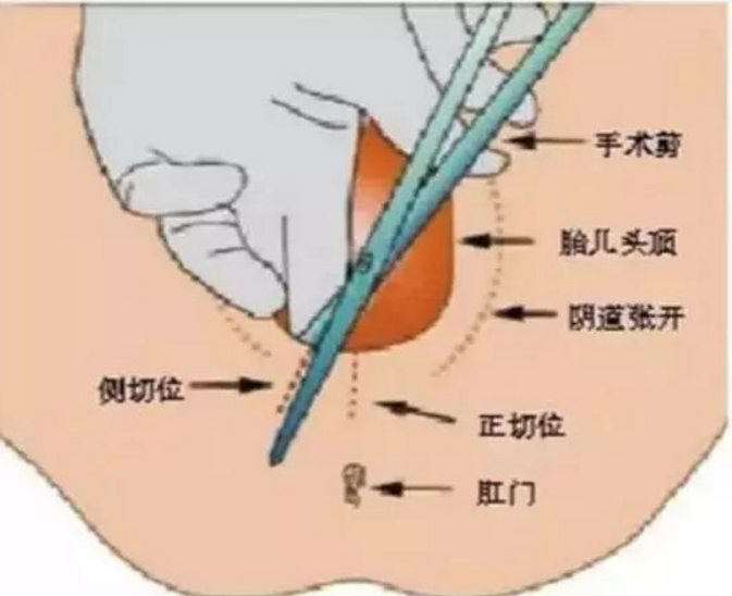 順產一定要側切嗎 怎樣可以避免側切