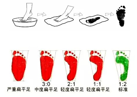 怎么知道寶寶是不是扁平足 怎么預防寶寶扁平足