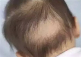 寶寶出現枕禿是因為缺鈣嗎 寶寶枕禿多大會長齊