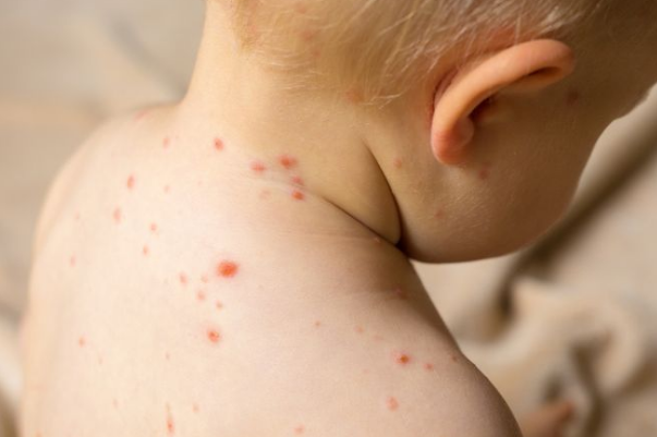 孩子上小學(xué)怎么預(yù)防水痘  小孩小學(xué)得了水痘怎么辦
