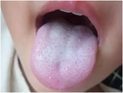 怎么知道孩子體內(nèi)是否有濕氣 孩子體內(nèi)濕氣如何判斷