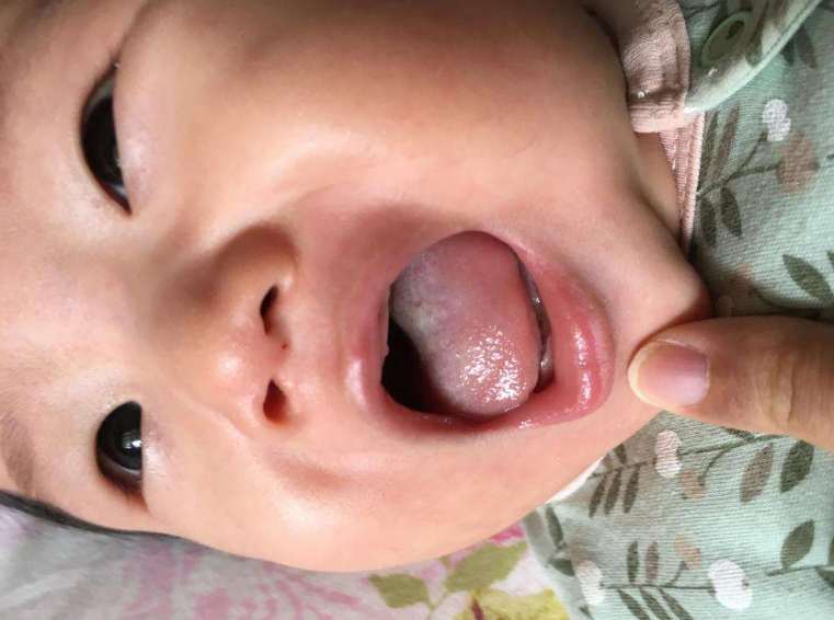 孩子鵝口瘡停藥后就反復怎么辦 孩子鵝口瘡正確護理方法 孩子鵝口瘡停藥后就反復怎么辦 孩子鵝口瘡正確護理方法